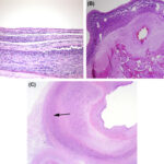 bacteroides endomyometritis