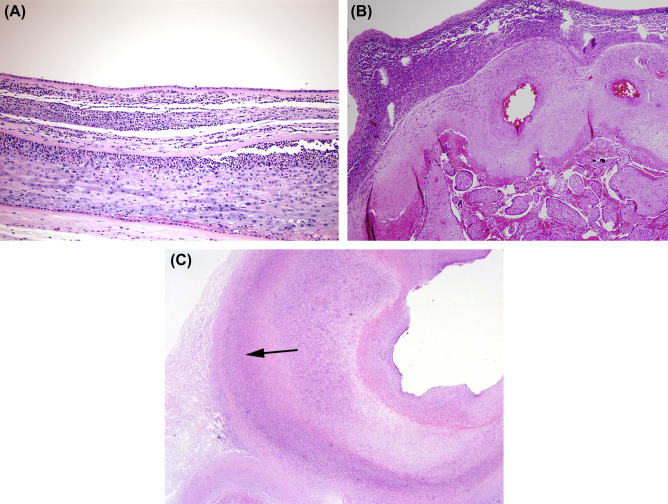 bacteroides endomyometritis