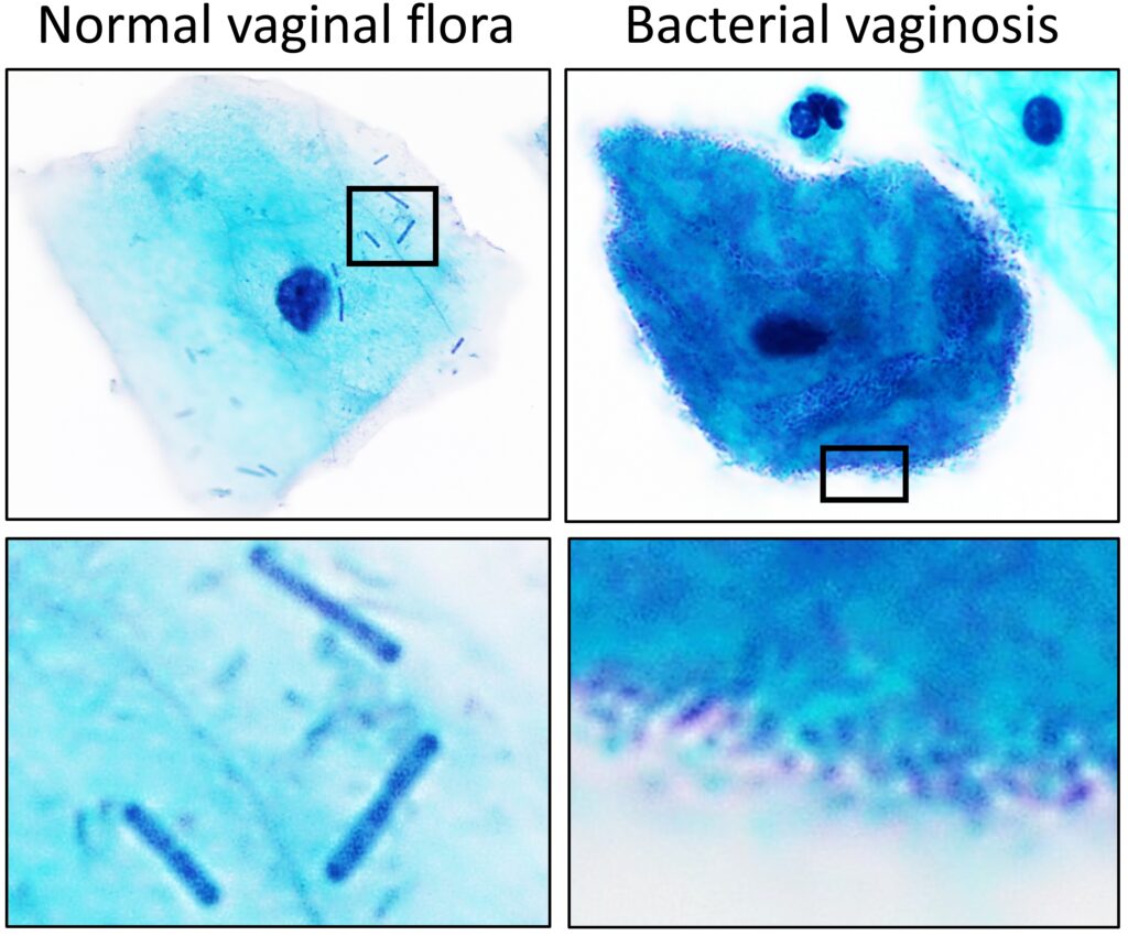 bacteroides gynecological infections