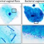 bacteroides gynecological infections