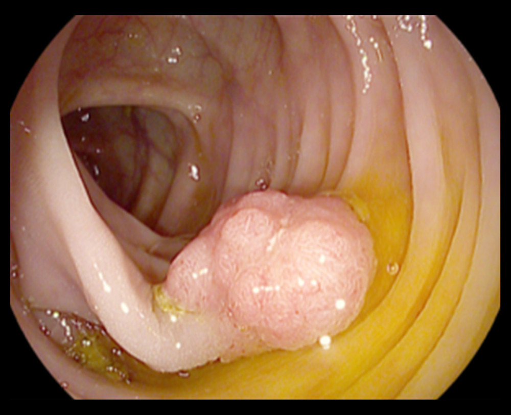 bacteroides joint infection