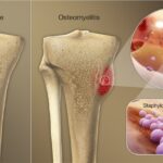 bacteroides osteomyelitis