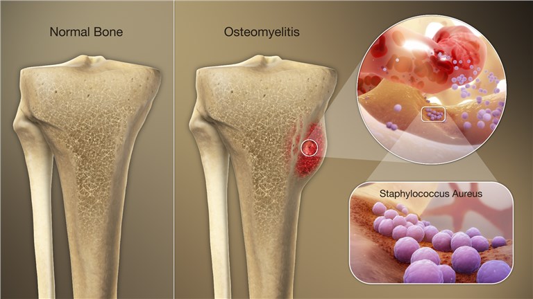 bacteroides osteomyelitis