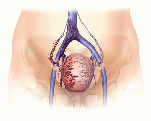 bacteroides pelvic cellulitis