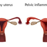 bacteroides pelvic inflammatory disease