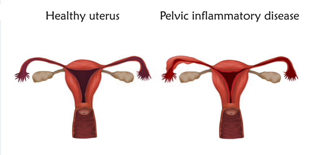 bacteroides pelvic inflammatory disease