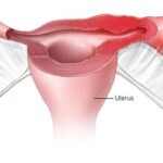 bacteroides tubo-ovarian abscess