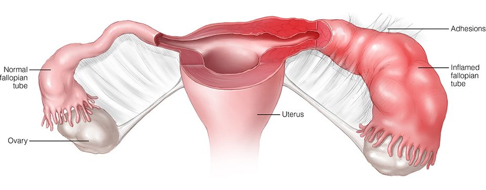 bacteroides tubo-ovarian abscess