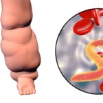 bancroft's filariasis