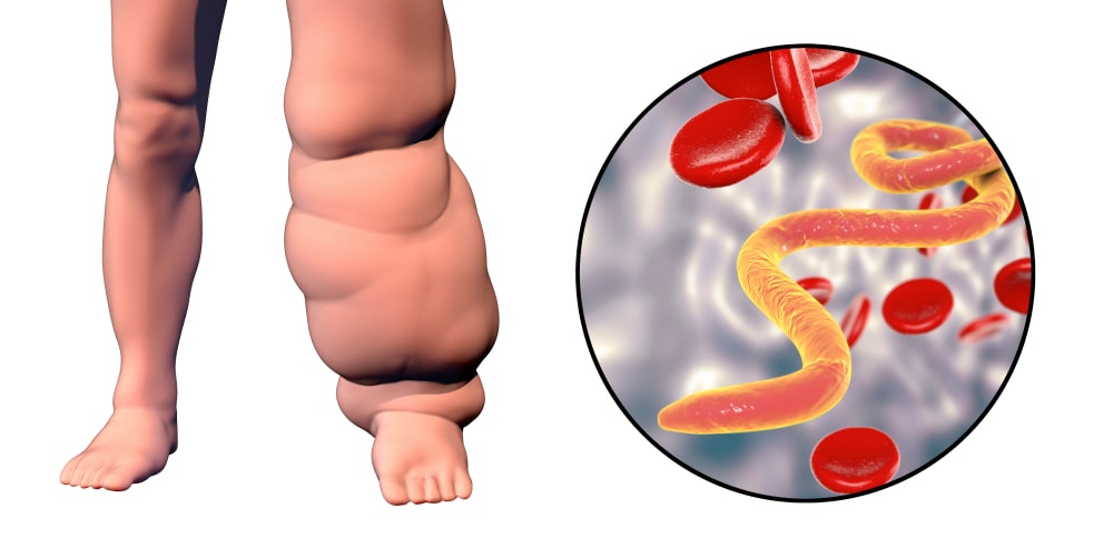 bancroft's filariasis