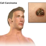 basal cell carcinoma of skin