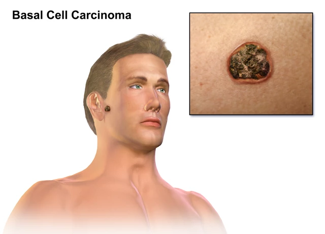 basal cell carcinoma of skin