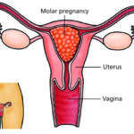 benign hydatidiform mole