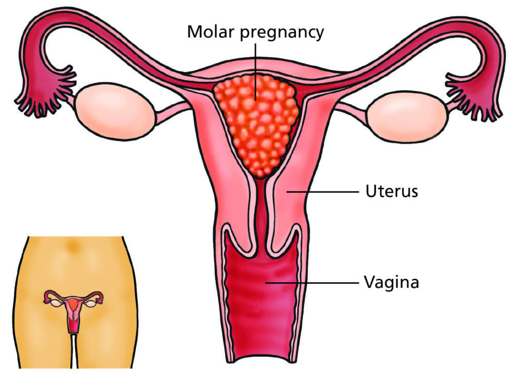 benign hydatidiform mole