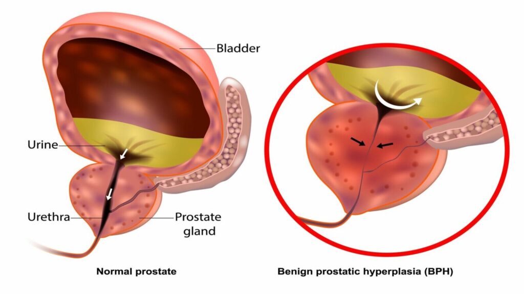 benign prostatic hyperplasia with lower urinary tract