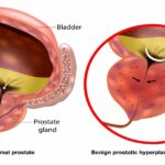 benign prostatic hyperplasia with lower urinary tract