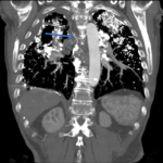 berylliosis