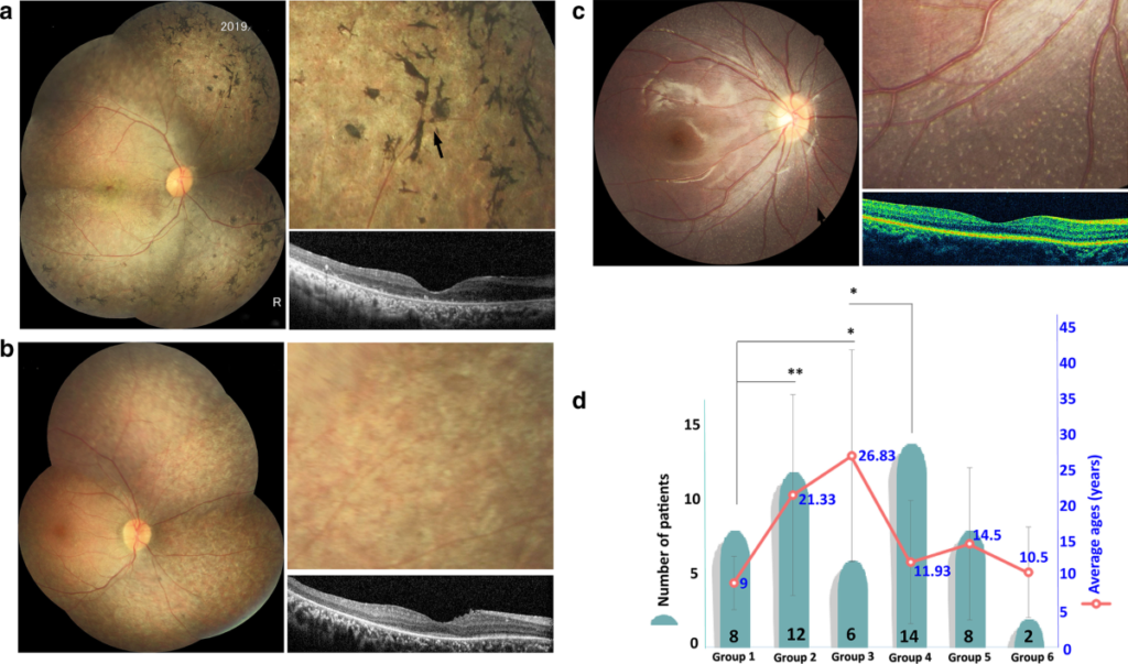 biallelic rpe65 mutation-associated retinal dystrophy