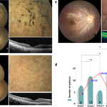 biallelic rpe65 mutation-associated retinal dystrophy