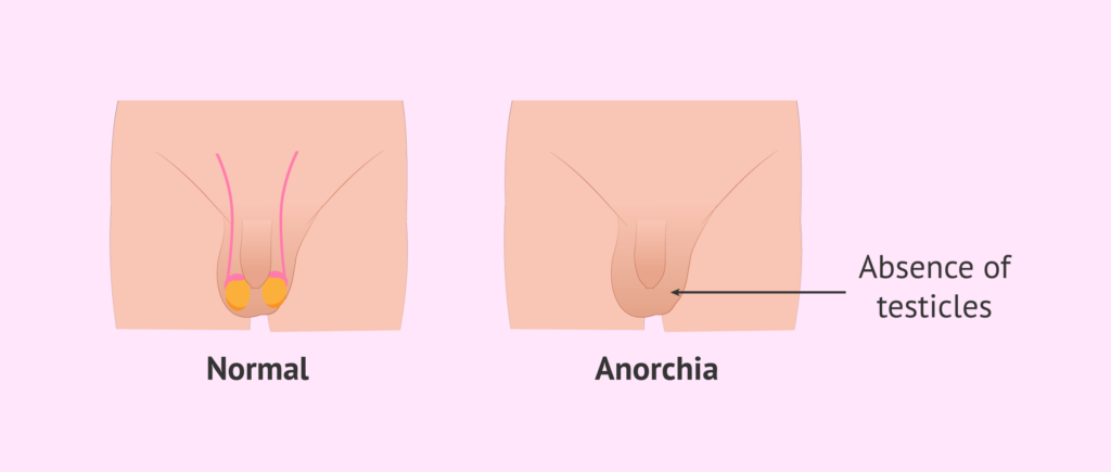 bilateral anorchia