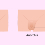 bilateral anorchia