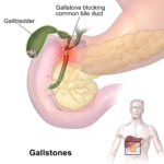 biliary calculus