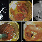 biliary tract infection