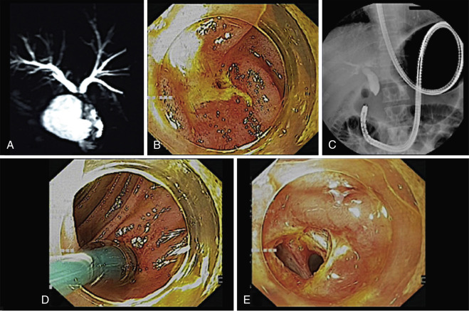 biliary tract infection