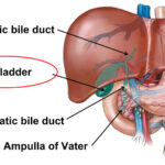 biliary tract malignancy