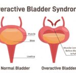 bladder hyperactivity