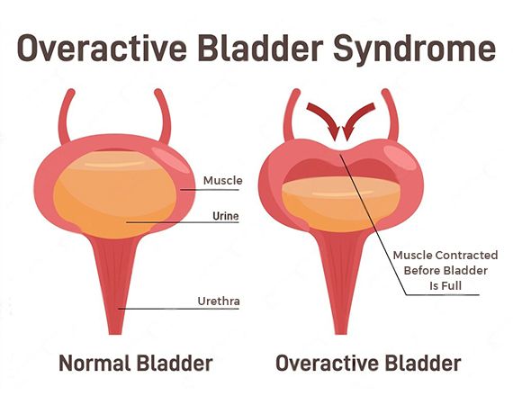 bladder hyperactivity