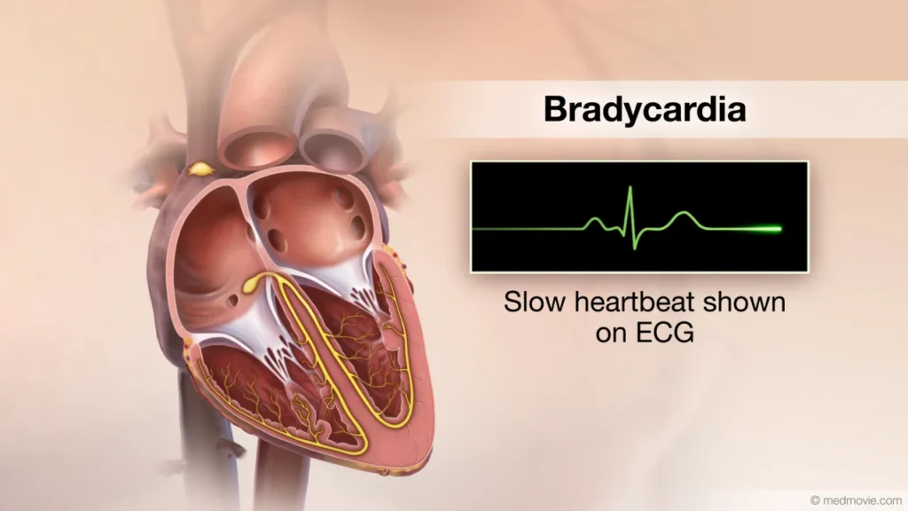 bradycardia