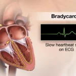 bradycardia