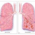 bronchiectasis