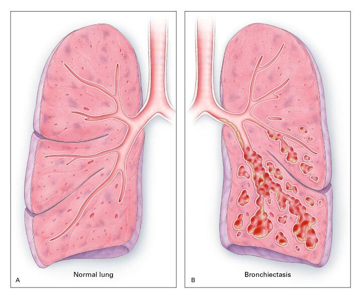 bronchiectasis