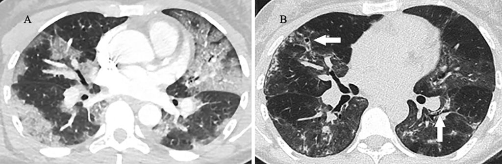 bronchiolitis obliterans with organizing pneumonia