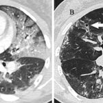 bronchiolitis obliterans with organizing pneumonia