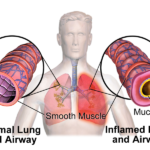 bronchospasm prevention