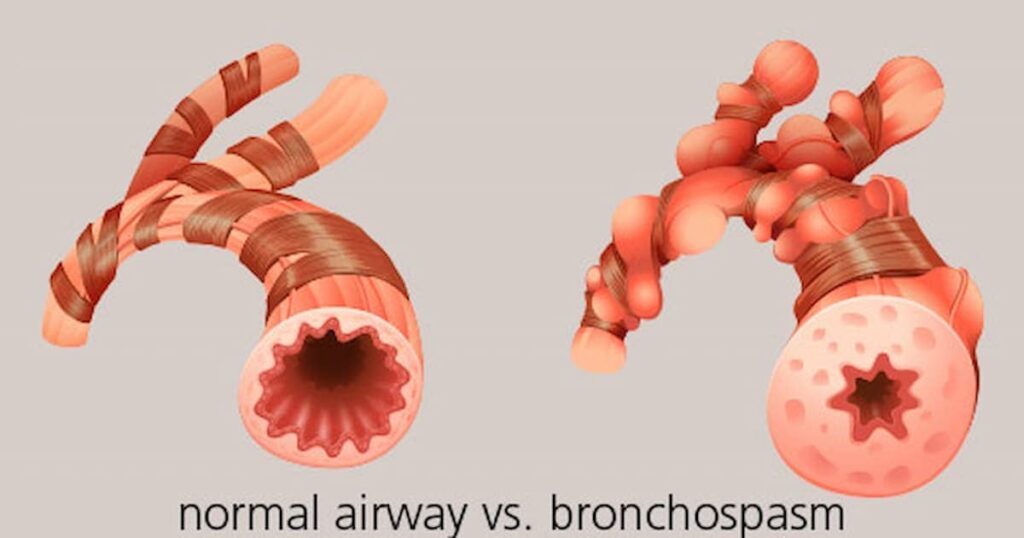 bronchospasm prevention with asthma