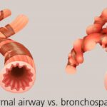 bronchospasm prevention with asthma