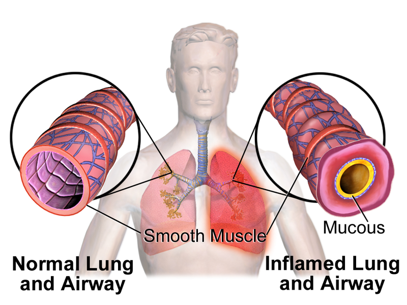 bronchospasm prevention