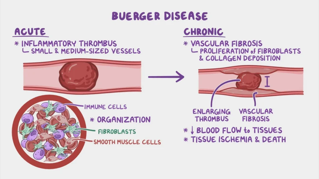 buerger's disease