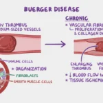 buerger's disease