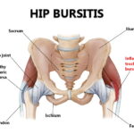 bursitis