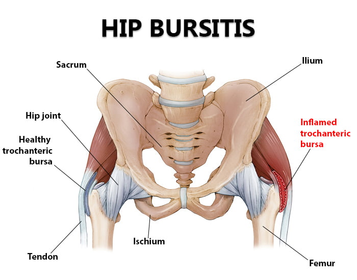 bursitis