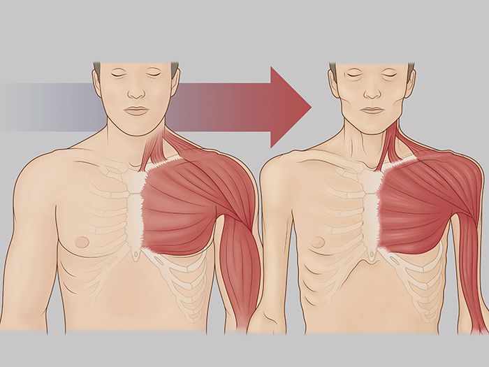 cachexia due to hiv