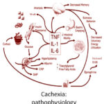 cachexia due to malignant neoplastic disease