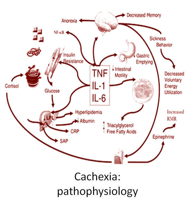 cachexia due to malignant neoplastic disease