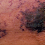 calciphylaxis