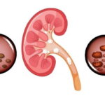 calcium renal calculi prevention